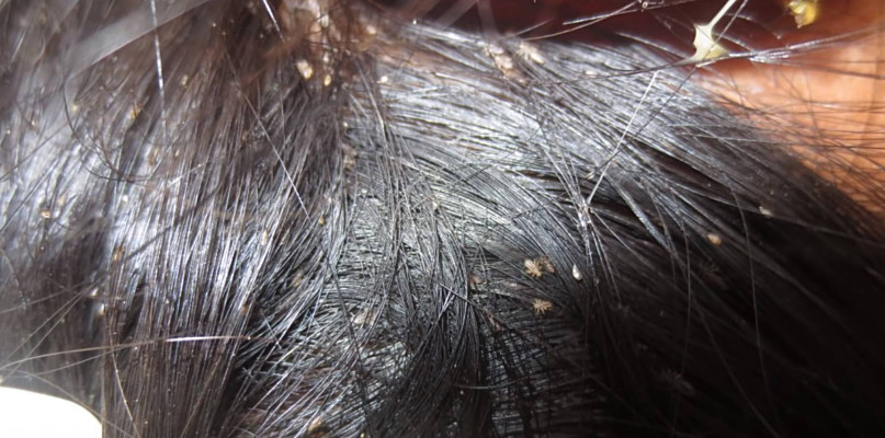 Wszawica w Mielcu? Jest nawet komunikat Sanepidu