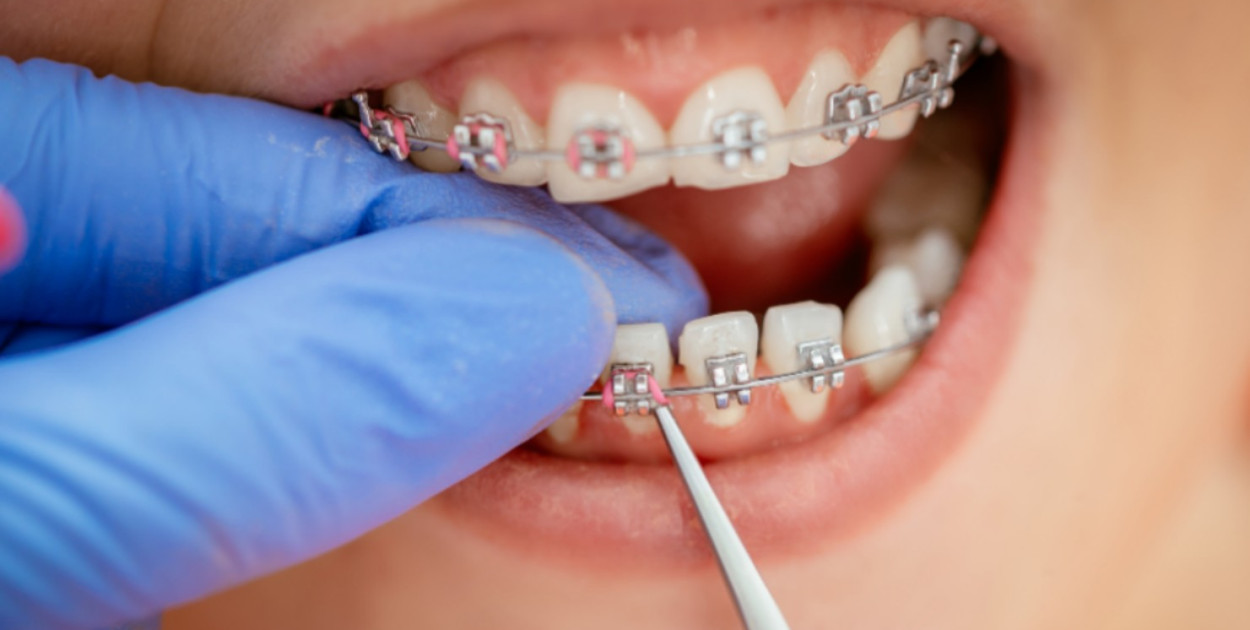 Aparat retencyjny - jego znaczenie dla prostego uśmiechu