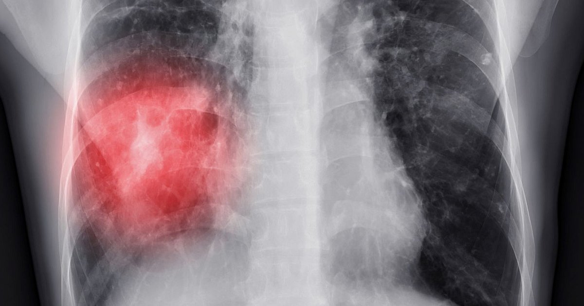 Szpital: 200 miejsc na badania wykrywające raka płuc - HEJ.MIELEC.PL